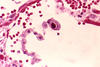 Photomicrograph showing human lung cells infected with cytomegalovirus. 