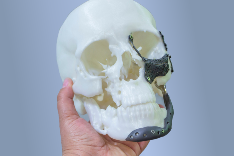 A model skull with additively manufactured facial prosthetics lining the jaw, chin, and cheek bone areas. The skull is held up for the camera.